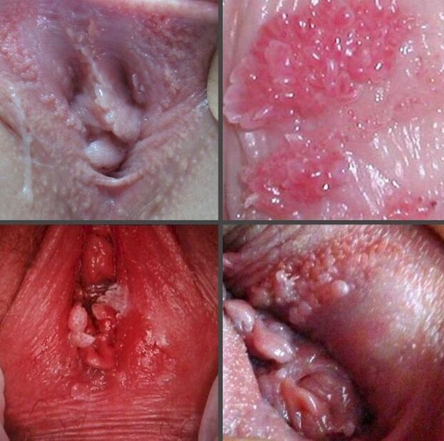 Vajinadaki papillomların yakın çekimi