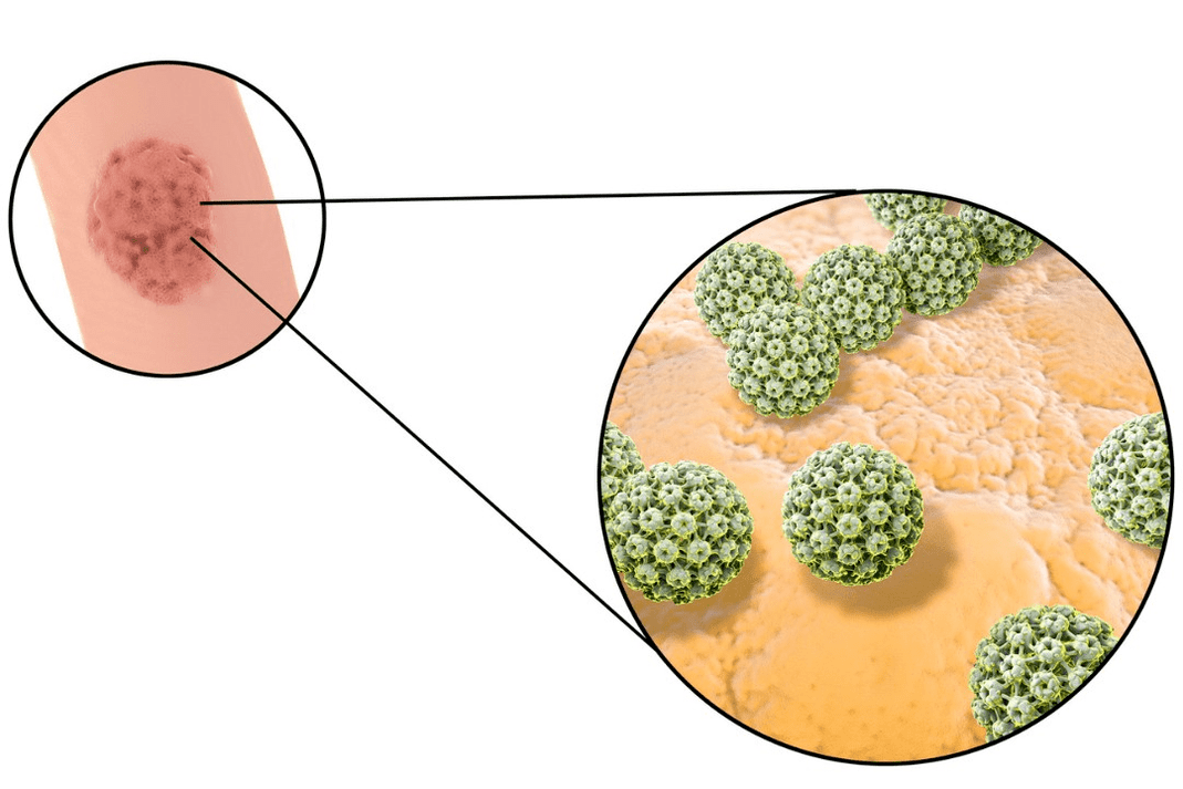 Skuamöz hücreli papilloma enfeksiyonunun kaynağı